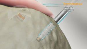 patch saddle nephew|Advanced Healing Construct: Double Row Rotator Cuff Repair  .